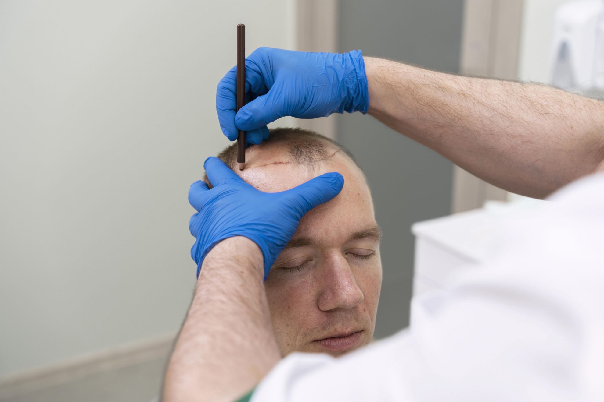 3000 Grafts Hair Transplant Cost in Turkey